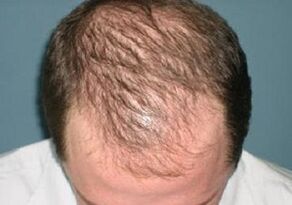 Ursachen für Haarausfall