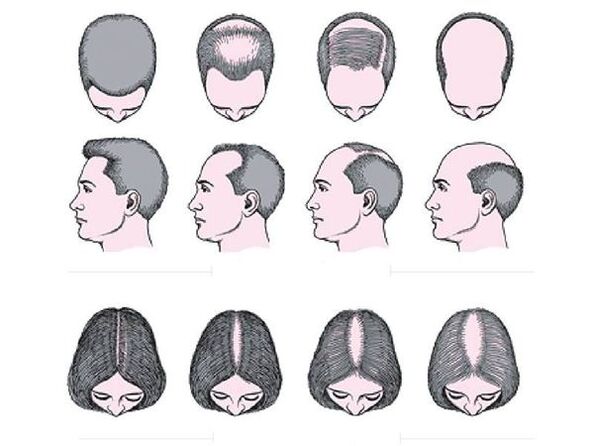 Androgenetische Alopezie bei Männern und Frauen.