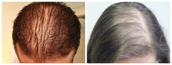 diffuse Alopezie