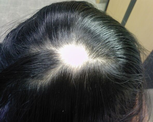 Alopecia areata oder Alopecia areata bei Frauen