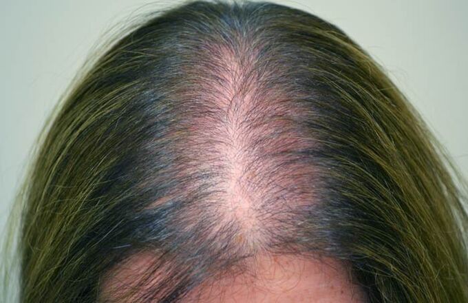 Alopezie (Kahlheit) bei Frauen