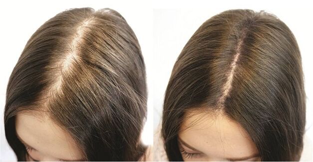 Das Ergebnis einer rechtzeitigen Behandlung von Alopezie bei Frauen.