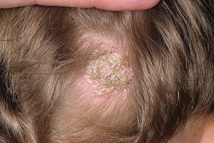 Seborrhoische Alopezie bei Frauen.