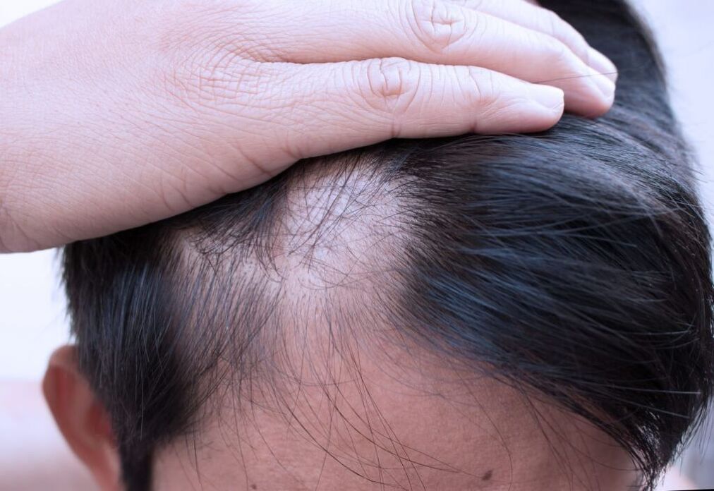 diffuse Alopezie des Kopfes
