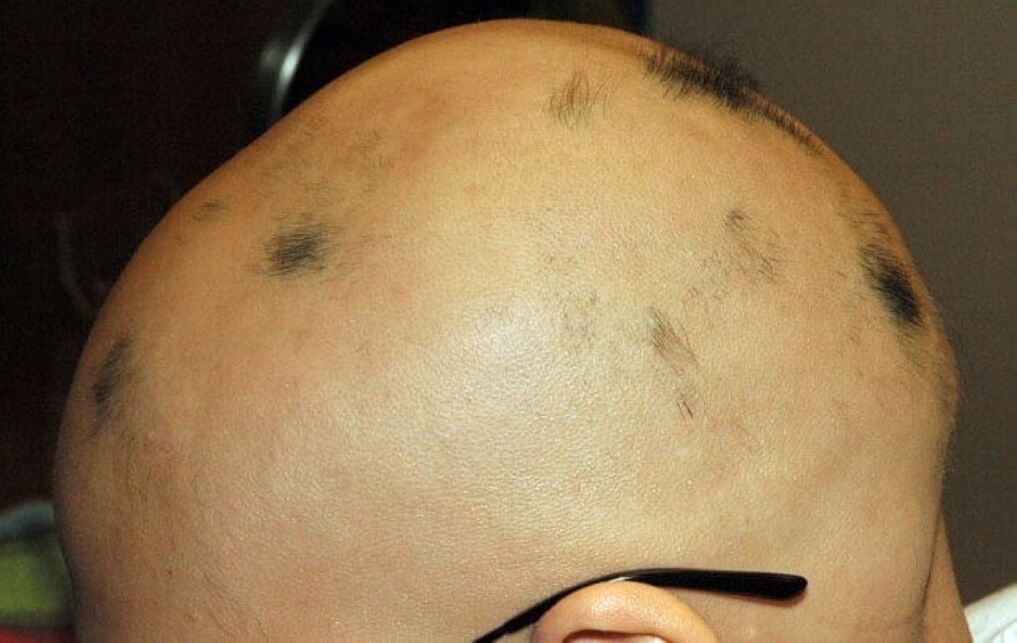 totale Alopezie der Kopfhaut bei einem Mann