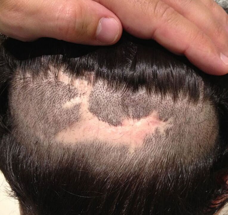 vernarbende Alopezie der Kopfhaut