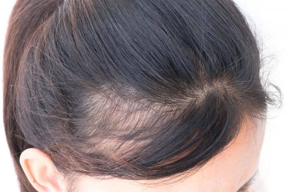 Androgene Alopezie bei Frauen.