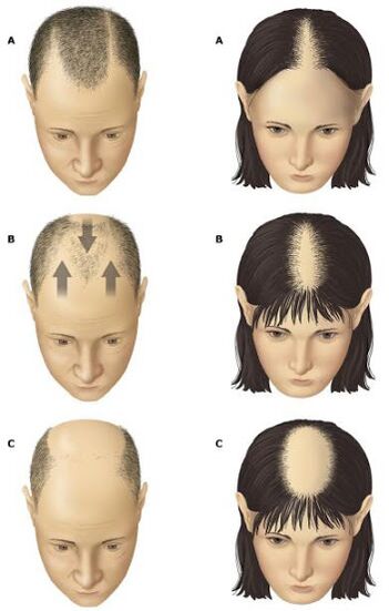 Androgene Alopezie bei Männern und Frauen.