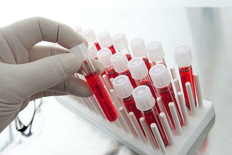 Blutuntersuchungen zur Verschreibung einer individuellen Behandlung von Alopezie
