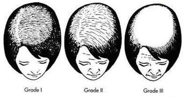 Grad androgener weiblicher Haarausfall