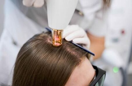 Lasertherapie bei androgenetischer Alopezie