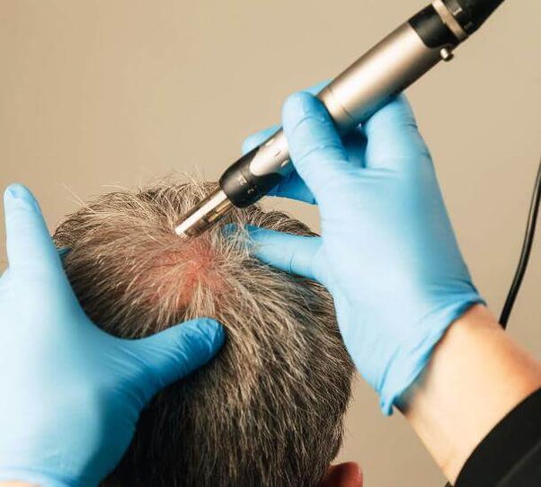 Physiotherapie zur Behandlung der androgenen Alopezie